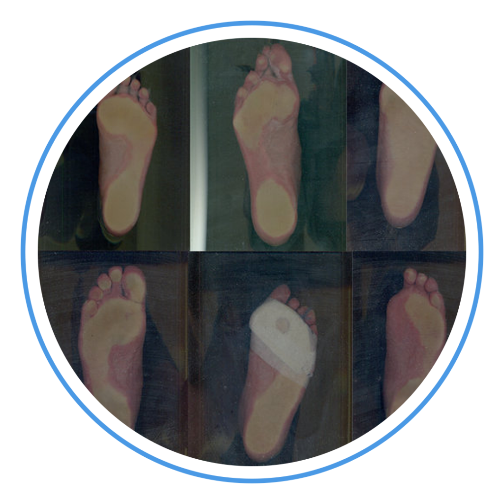 peslocus-physio-pysiotherapy-foot-deformities+8